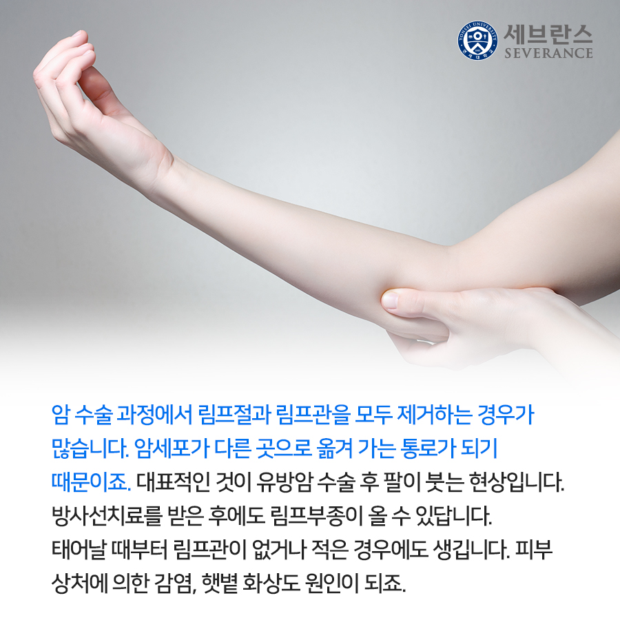 암 수술 과정에서 림프절과 림프관을 모두 제거하는 경우가 많습니다. 암세포가 다른 곳으로 옮겨 가는 통로가 되기 때문이죠.  대표적인 것이 유방암 수술 후 팔이 붓는 현상입니다. 방사선치료를 받은 후에도 림프부종이 올 수 있답니다. 태어날 때부터 림프관이 없거나 적은 경우에도 생깁니다. 피부 상처에 의한 감염, 햇볕 화상도 원인이 되죠.