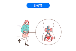 방광염