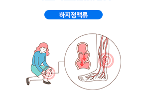 하지정맥류